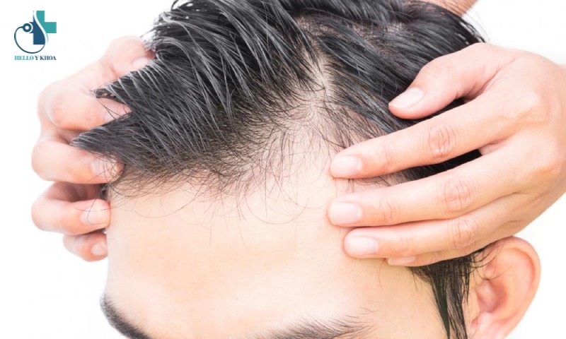Nguyên nhân gây rụng tóc ở nam giới tuổi 30