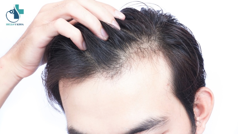 Nguyên nhân gây rụng tóc nhiều ở nam