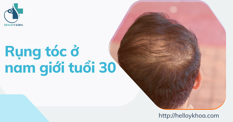 Rụng tóc ở nam giới tuổi 30: Nguyên nhân và cách khắc phục