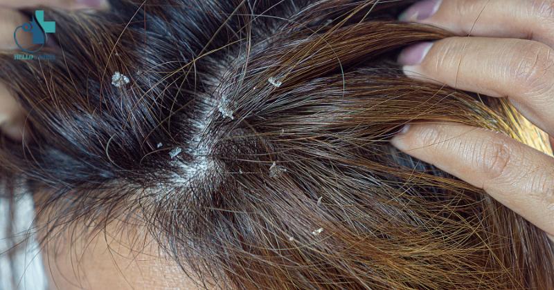 Bị rụng tóc nhiều do nấm da đầu