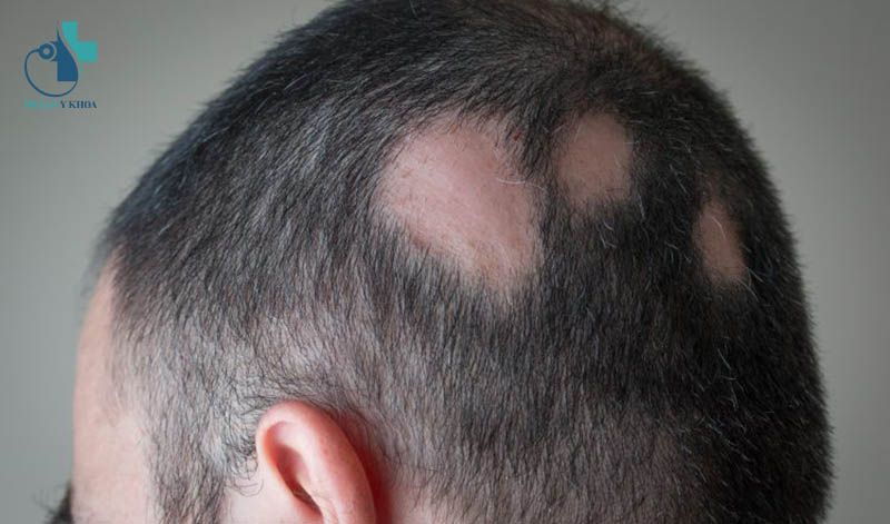 Tùy thuộc vào nguyên nhân gây rụng tóc mảng mà tóc có thể mọc lại hoặc không?
