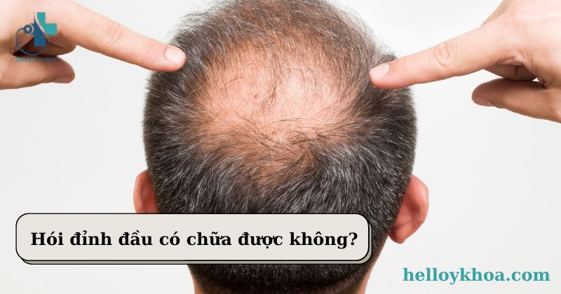 Những điều cần biết để khắc phục tóc thưa hói ở đỉnh đầu  Cấy Tóc Quốc Tế