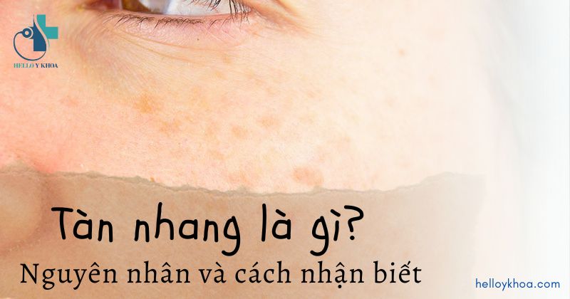 Tàn nhang là gì?