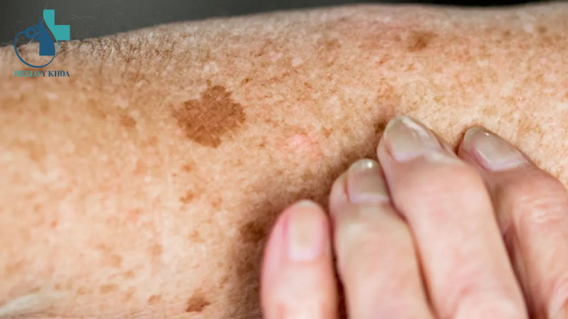 Đốm đồi mồi nổi trên da có thể là dấu hiệu của bệnh lý