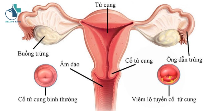 ra khí hư màu hồng nhạt là triệu chứng của bệnh lý viêm lộ tuyến cổ tử cung