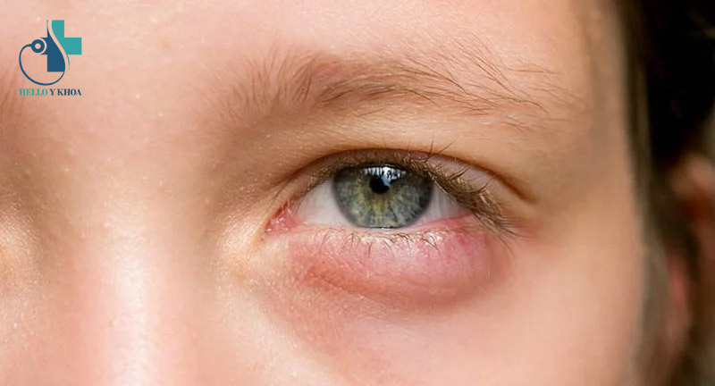 Bọng mắt có thể là biểu hiện của nhiều bệnh lý