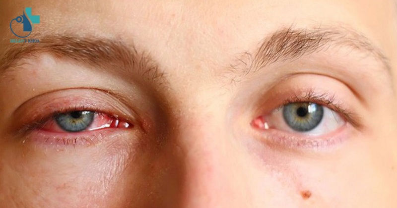đau mắt đỏ là gì
