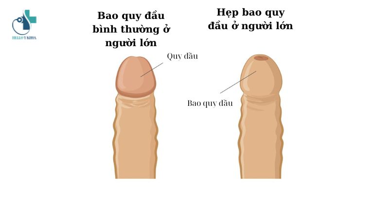 hình ảnh hẹp bao quy đầu