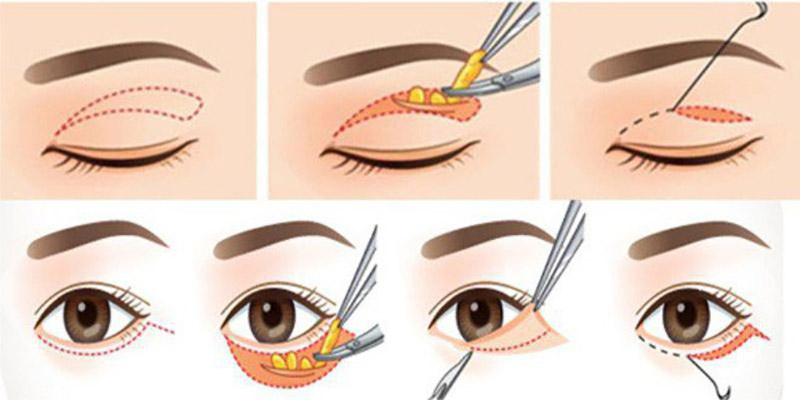 Quy trình phẫu thuật tách mỡ bọng mắt