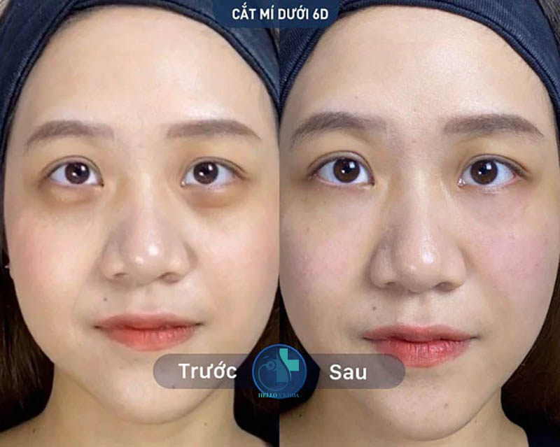 Hình ảnh trước và sau khi bóc mỡ mắt nội soi