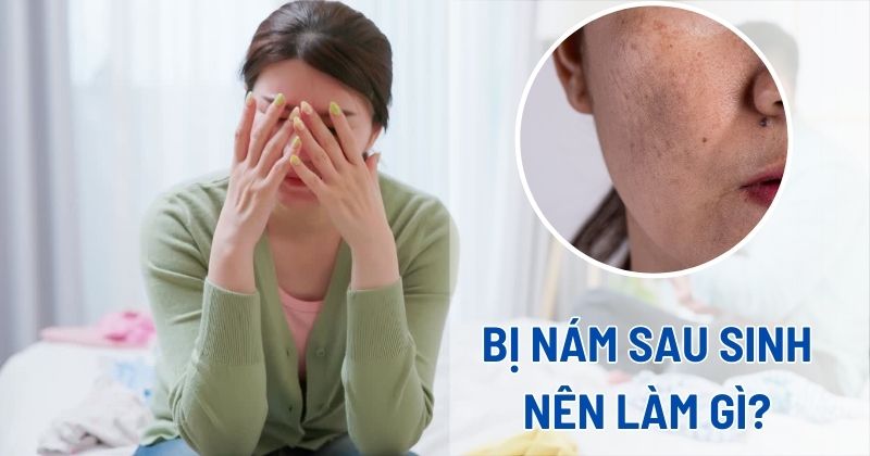 Bị nám da sau sinh nên làm gì?