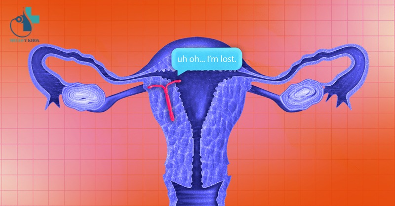 vòng tránh thai bị lệch khỏi vị trí ban đầu