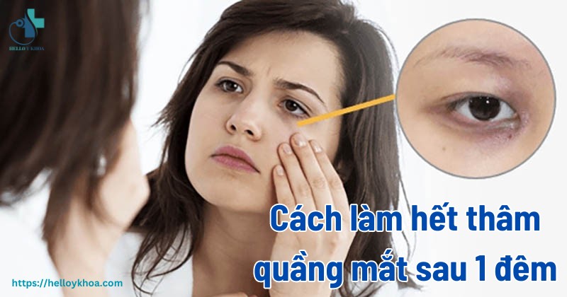 Cách làm hết thâm quầng mắt sau 1 đêm